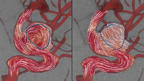 Технология AneurysmFlow от Philips